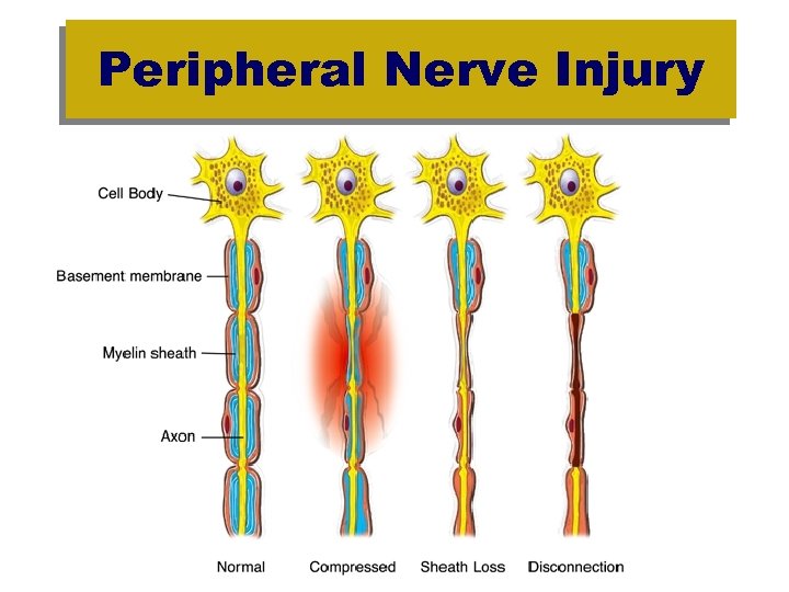 Peripheral Nerve Injury 