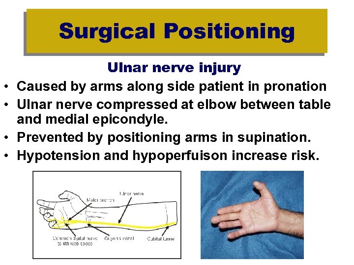Surgical Positioning • • Ulnar nerve injury Caused by arms along side patient in