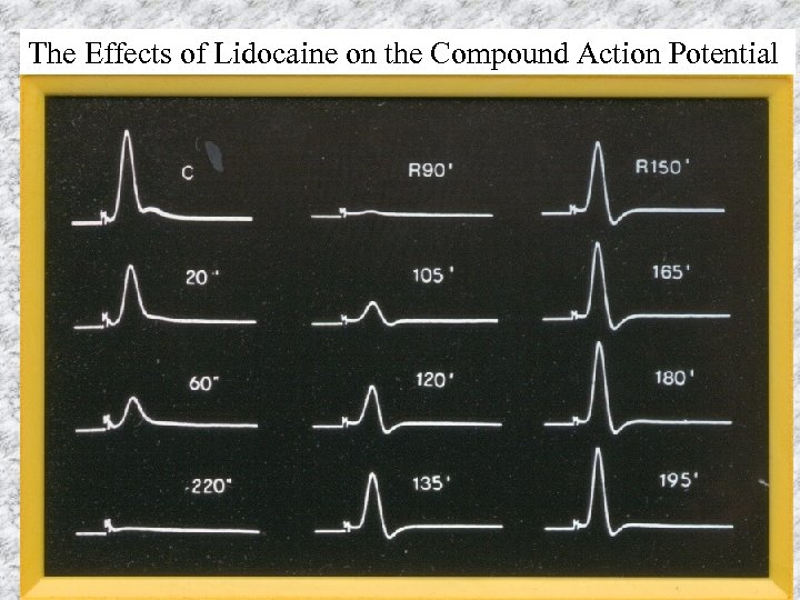 The Effects of Lidocaine on the Compound Action Potential 