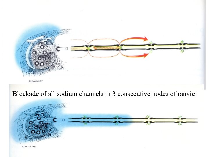 Blockade of all sodium channels in 3 consecutive nodes of ranvier 
