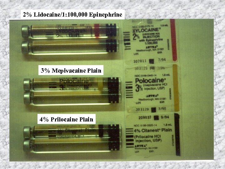 2% Lidocaine/1: 100, 000 Epinephrine 3% Mepivacaine Plain 4% Prilocaine Plain 