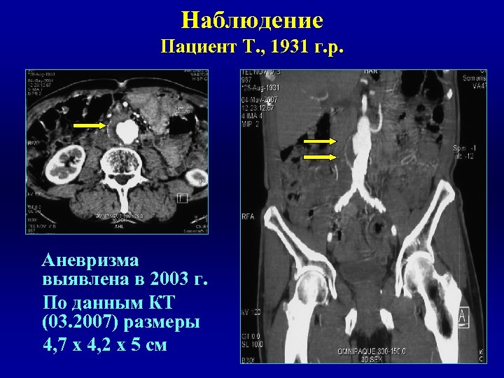 Наблюдение Пациент Т. , 1931 г. р. Аневризма выявлена в 2003 г. По данным