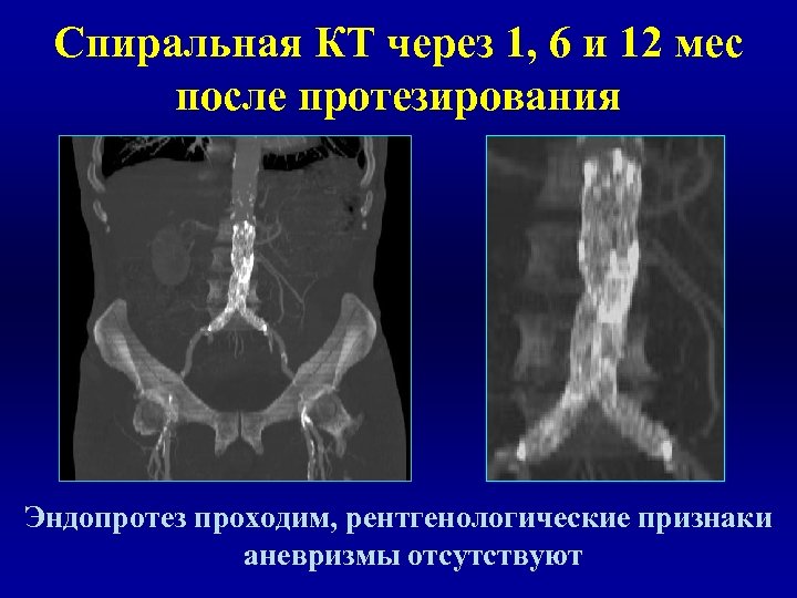 Спиральная КТ через 1, 6 и 12 мес после протезирования Эндопротез проходим, рентгенологические признаки