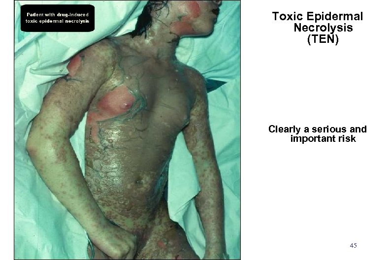 Toxic Epidermal Necrolysis (TEN) Clearly a serious and important risk 45 