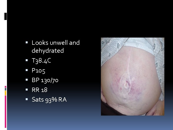  Looks unwell and dehydrated T 38. 4 C P 105 BP 130/70 RR