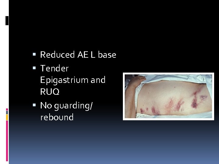  Reduced AE L base Tender Epigastrium and RUQ No guarding/ rebound 