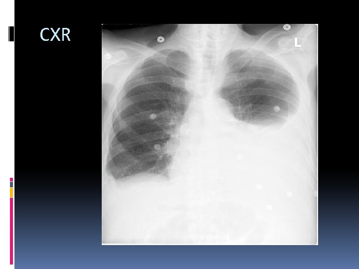 CXR 