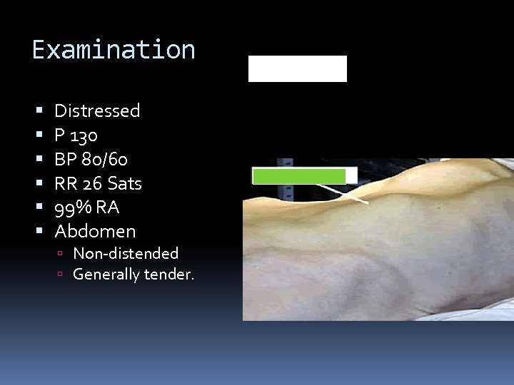 Examination Distressed P 130 BP 80/60 RR 26 Sats 99% RA Abdomen Non-distended Generally