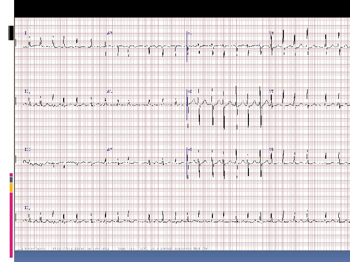 ECG 