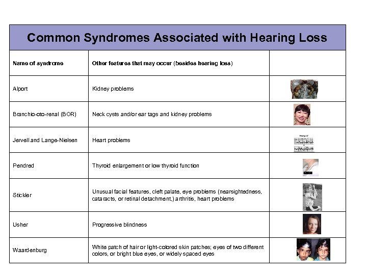 Common Syndromes Associated with Hearing Loss Name of syndrome Other features that may occur
