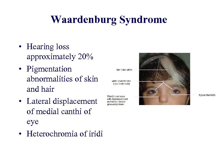 Waardenburg Syndrome • Hearing loss approximately 20% • Pigmentation abnormalities of skin and hair