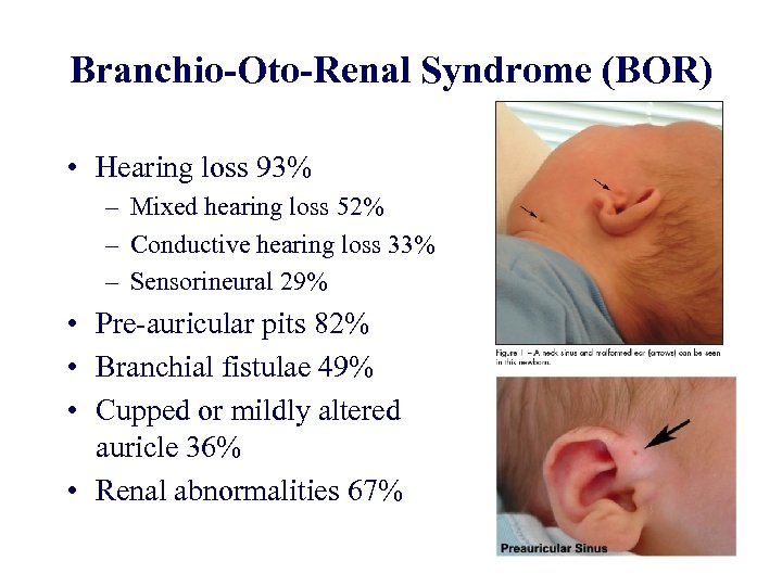 Branchio-Oto-Renal Syndrome (BOR) • Hearing loss 93% – Mixed hearing loss 52% – Conductive