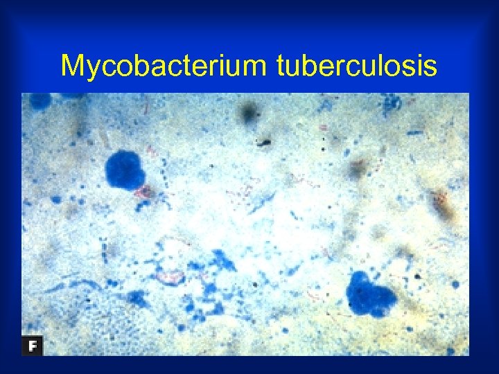 Mycobacterium tuberculosis 