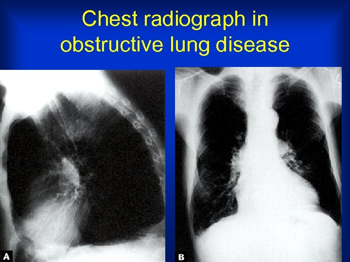 Chest radiograph in obstructive lung disease 