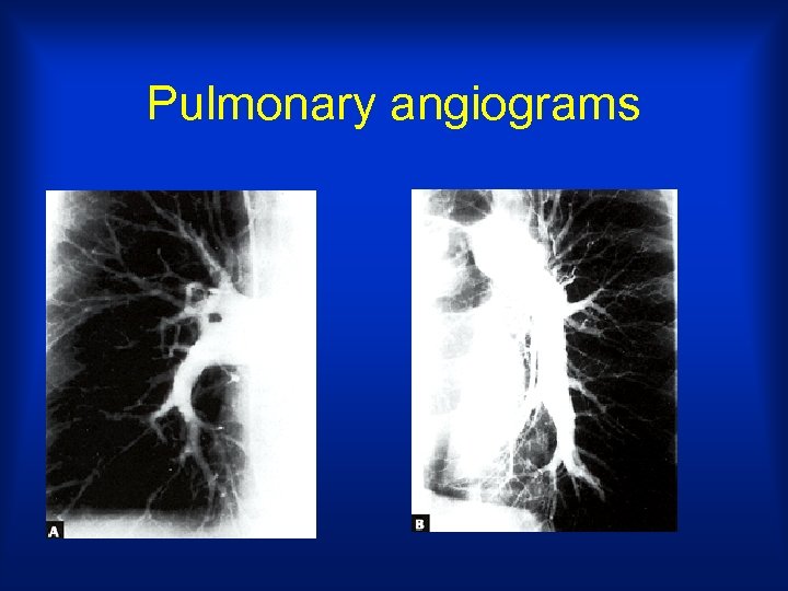 Pulmonary angiograms 