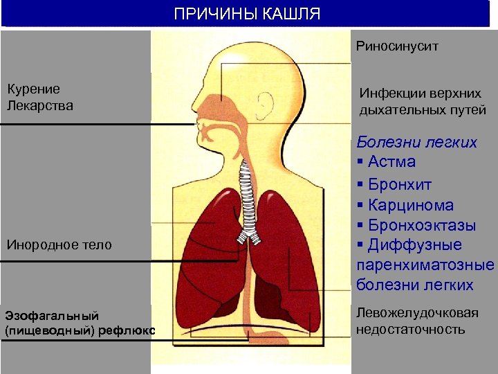 ПРИЧИНЫ КАШЛЯ Риносинусит Курение Лекарства Инородное тело Эзофагальный (пищеводный) рефлюкс Инфекции верхних дыхательных путей