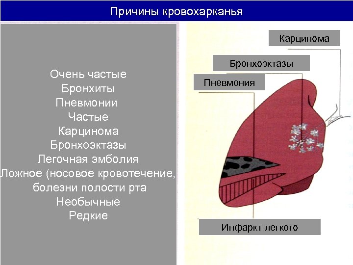 Причины кровохарканья Карцинома Очень частые Бронхиты Пневмонии Частые Карцинома Бронхоэктазы Легочная эмболия Ложное (носовое