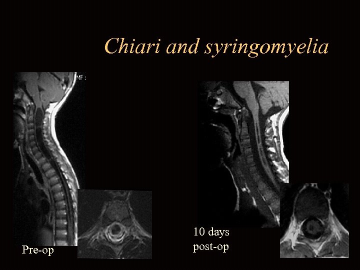 Chiari and syringomyelia Pre-op 10 days post-op 