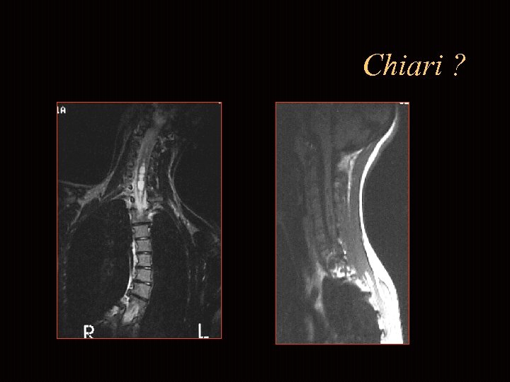 Chiari ? 