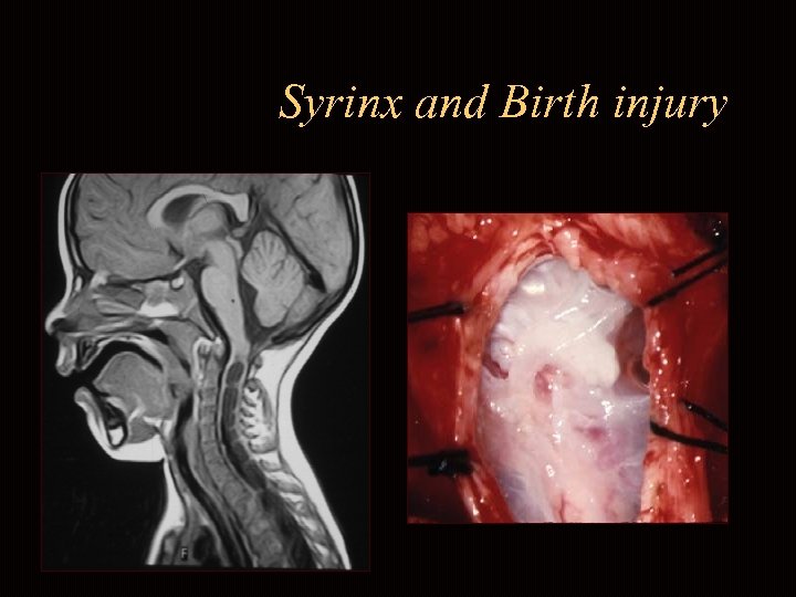 Syrinx and Birth injury 