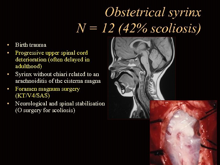Obstetrical syrinx N = 12 (42% scoliosis) • Birth trauma • Progressive upper spinal