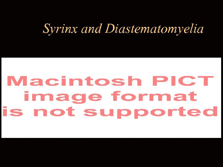 Syrinx and Diastematomyelia 