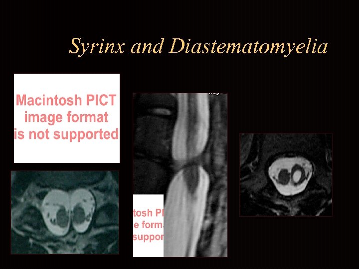 Syrinx and Diastematomyelia 