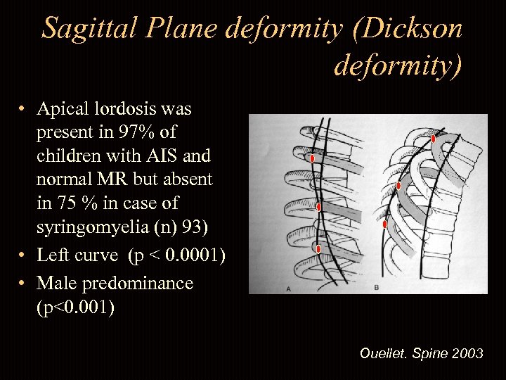 Sagittal Plane deformity (Dickson deformity) • Apical lordosis was present in 97% of children