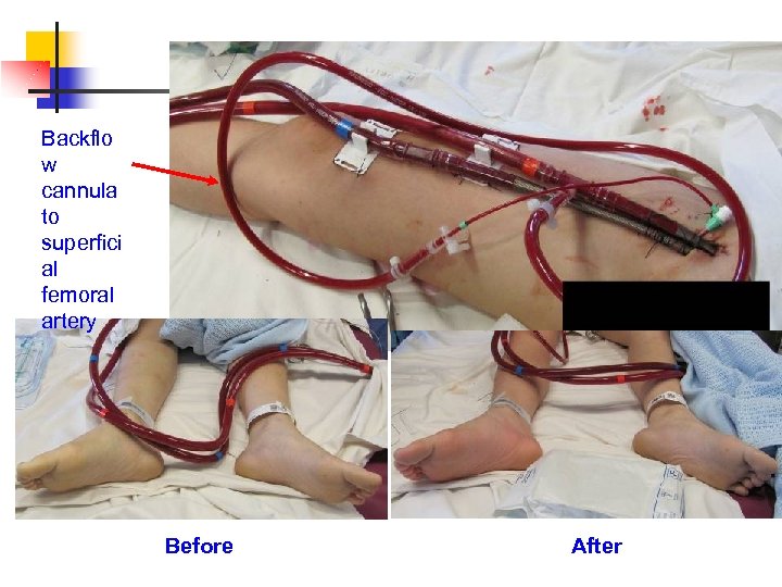 Backflo w cannula to superfici al femoral artery Photos showing backflow cannulae & ECMO