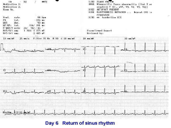 Day 6 Return of sinus rhythm 