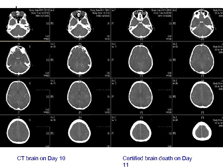 CT brain on Day 10 Certified brain death on Day 11 