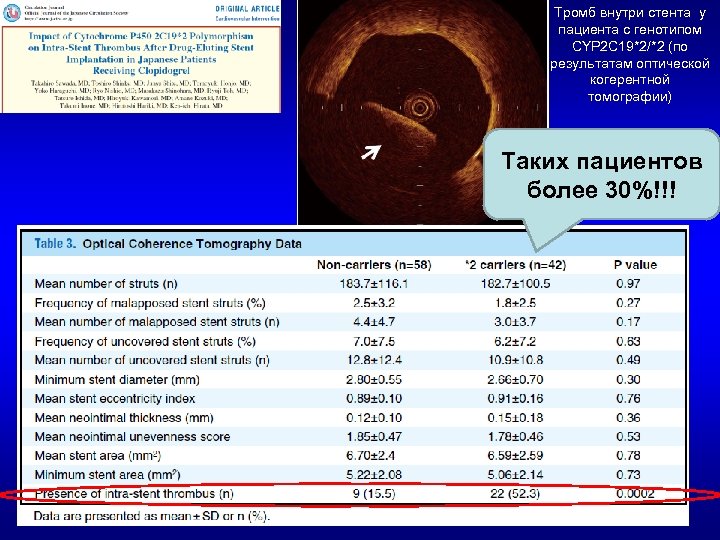 Тромб внутри стента у пациента с генотипом CYP 2 C 19*2/*2 (по результатам оптической