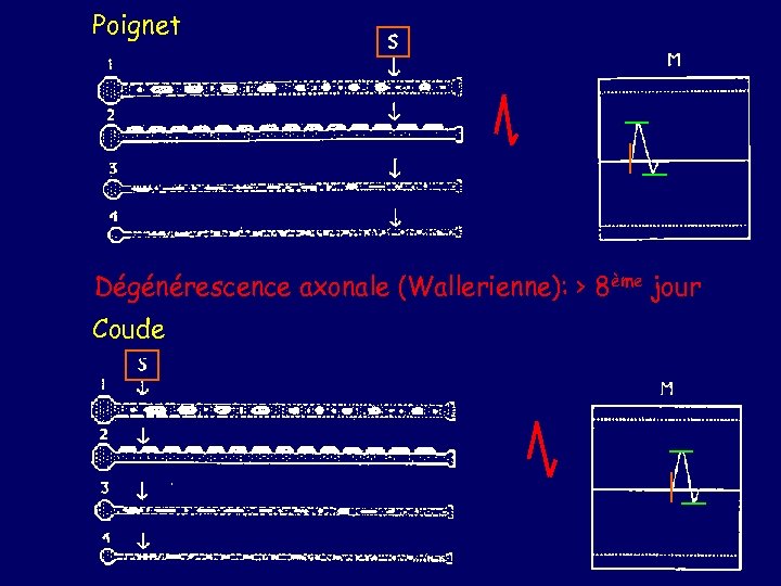 Poignet Dégénérescence axonale (Wallerienne): > 8ème jour Coude 