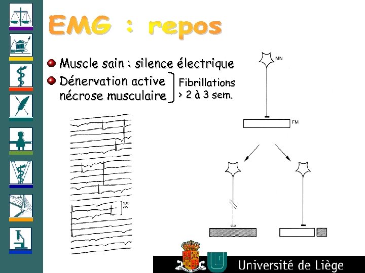 Muscle sain : silence électrique Dénervation active Fibrillations nécrose musculaire > 2 à 3