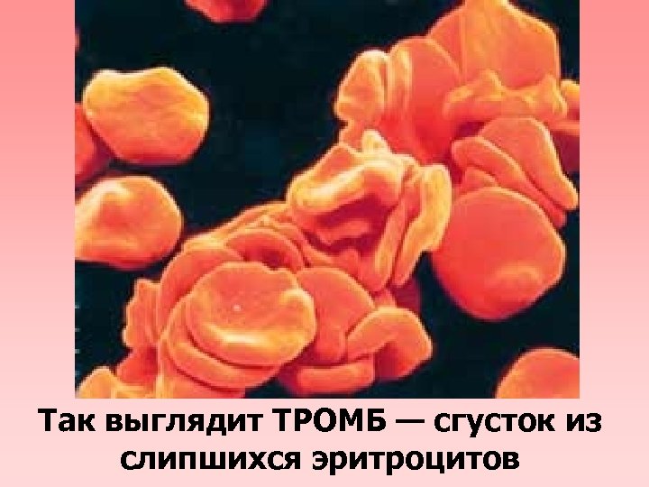 Так выглядит ТРОМБ — сгусток из слипшихся эритроцитов 