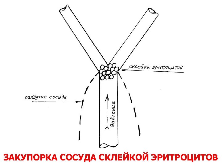 ЗАКУПОРКА СОСУДА СКЛЕЙКОЙ ЭРИТРОЦИТОВ 