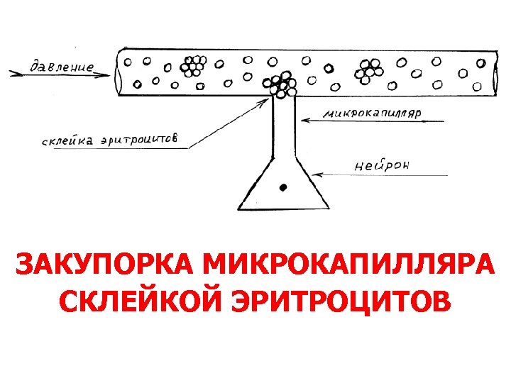 ЗАКУПОРКА МИКРОКАПИЛЛЯРА СКЛЕЙКОЙ ЭРИТРОЦИТОВ 