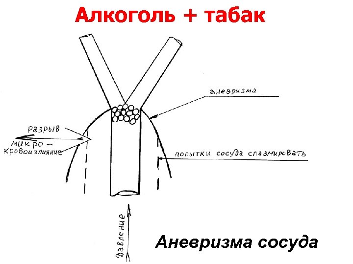 Алкоголь + табак Аневризма сосуда 
