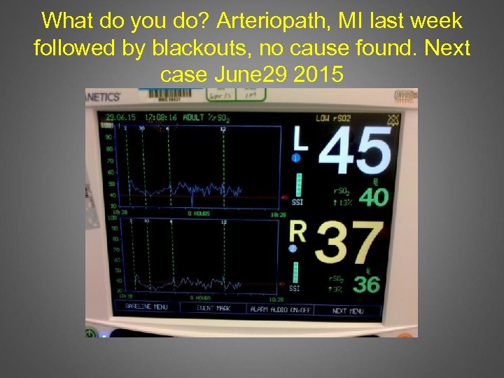 What do you do? Arteriopath, MI last week followed by blackouts, no cause found.