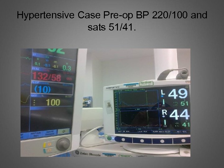 Hypertensive Case Pre-op BP 220/100 and sats 51/41. 