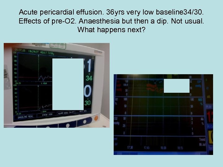 Acute pericardial effusion. 36 yrs very low baseline 34/30. Effects of pre-O 2. Anaesthesia