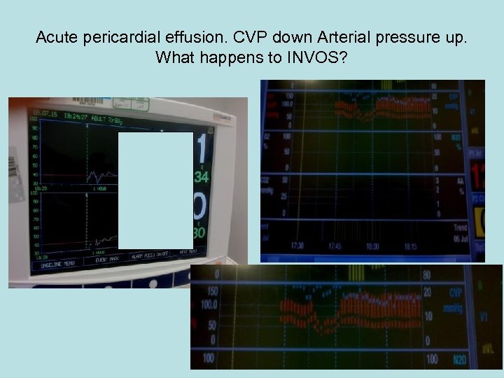 Acute pericardial effusion. CVP down Arterial pressure up. What happens to INVOS? 