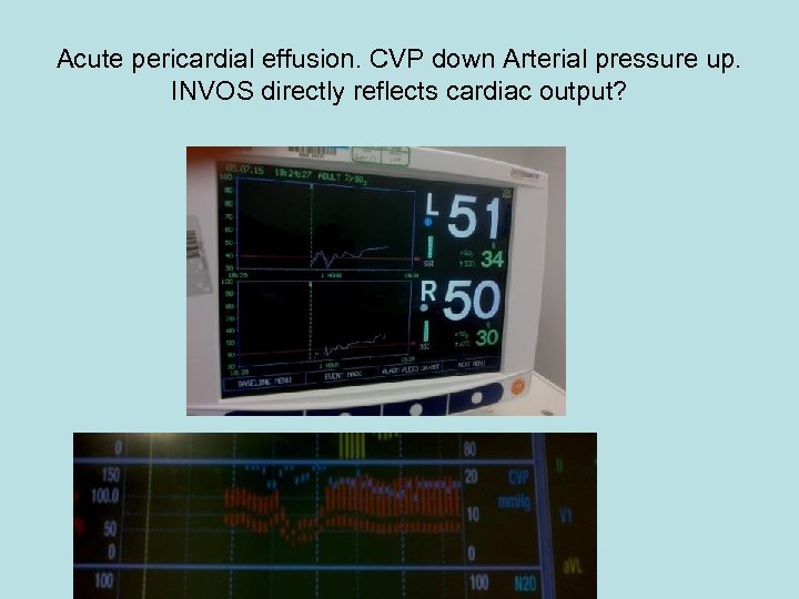Acute pericardial effusion. CVP down Arterial pressure up. INVOS directly reflects cardiac output? 