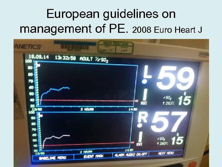 European guidelines on management of PE. 2008 Euro Heart J 