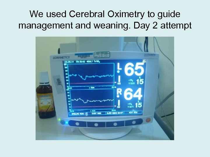 We used Cerebral Oximetry to guide management and weaning. Day 2 attempt 
