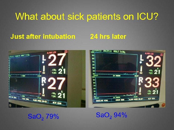 What about sick patients on ICU? Just after intubation Sa. O 2 79% 24