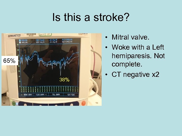 Is this a stroke? 65% 38% • Mitral valve. • Woke with a Left