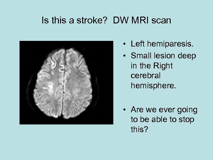 Is this a stroke? DW MRI scan • Left hemiparesis. • Small lesion deep