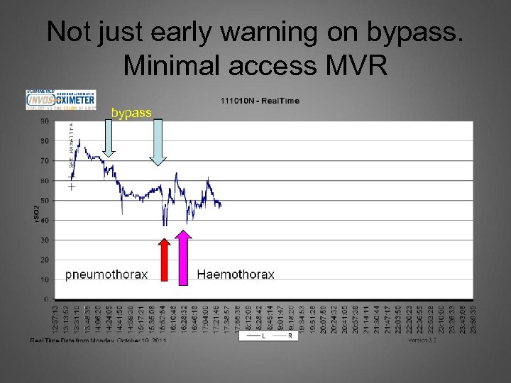 Not just early warning on bypass. Minimal access MVR bypass 