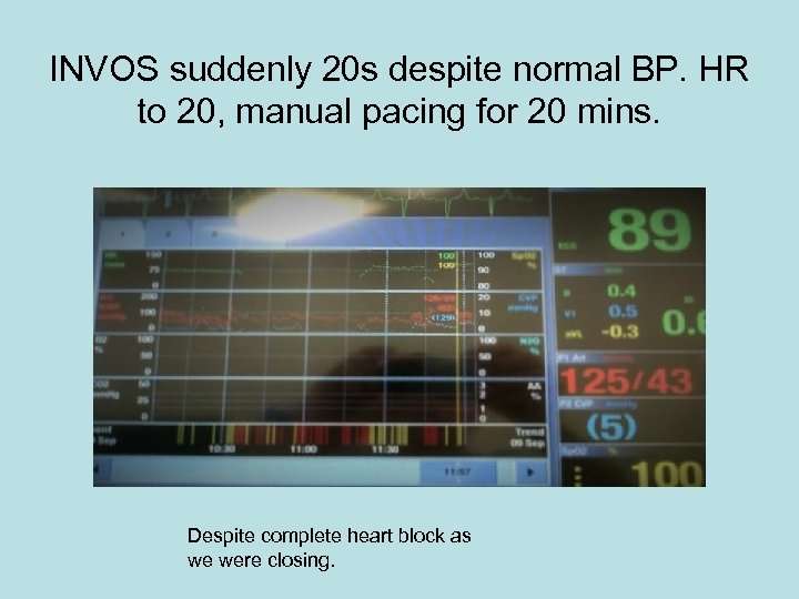 INVOS suddenly 20 s despite normal BP. HR to 20, manual pacing for 20